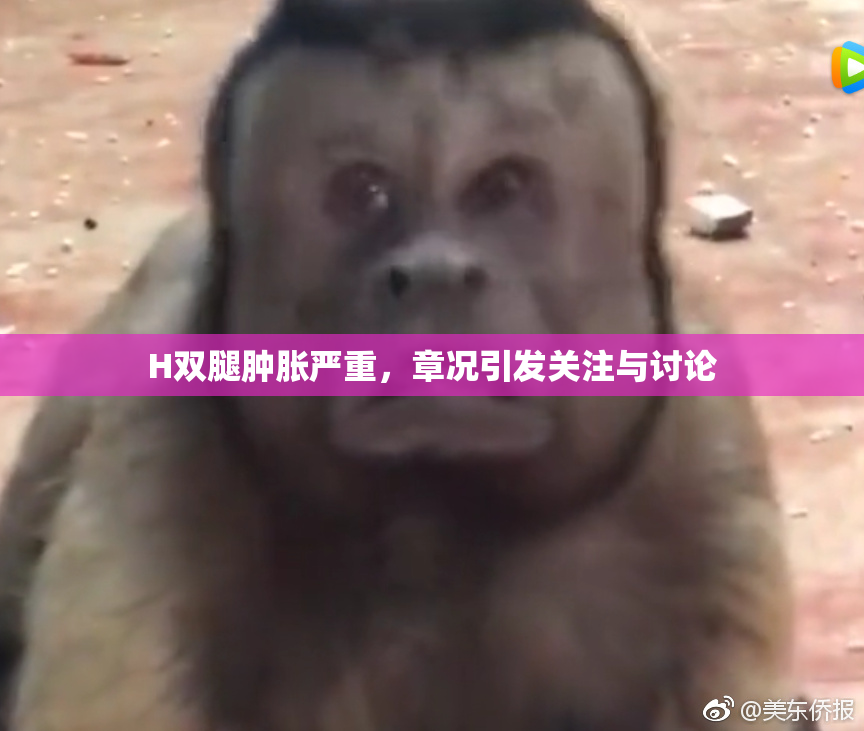 H双腿肿胀严重，章况引发关注与讨论