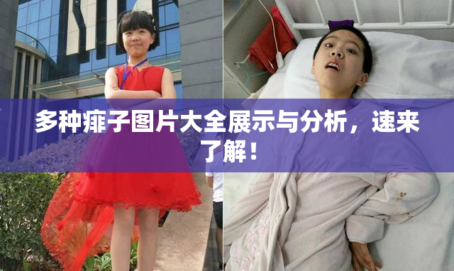 多种痱子图片大全展示与分析，速来了解！